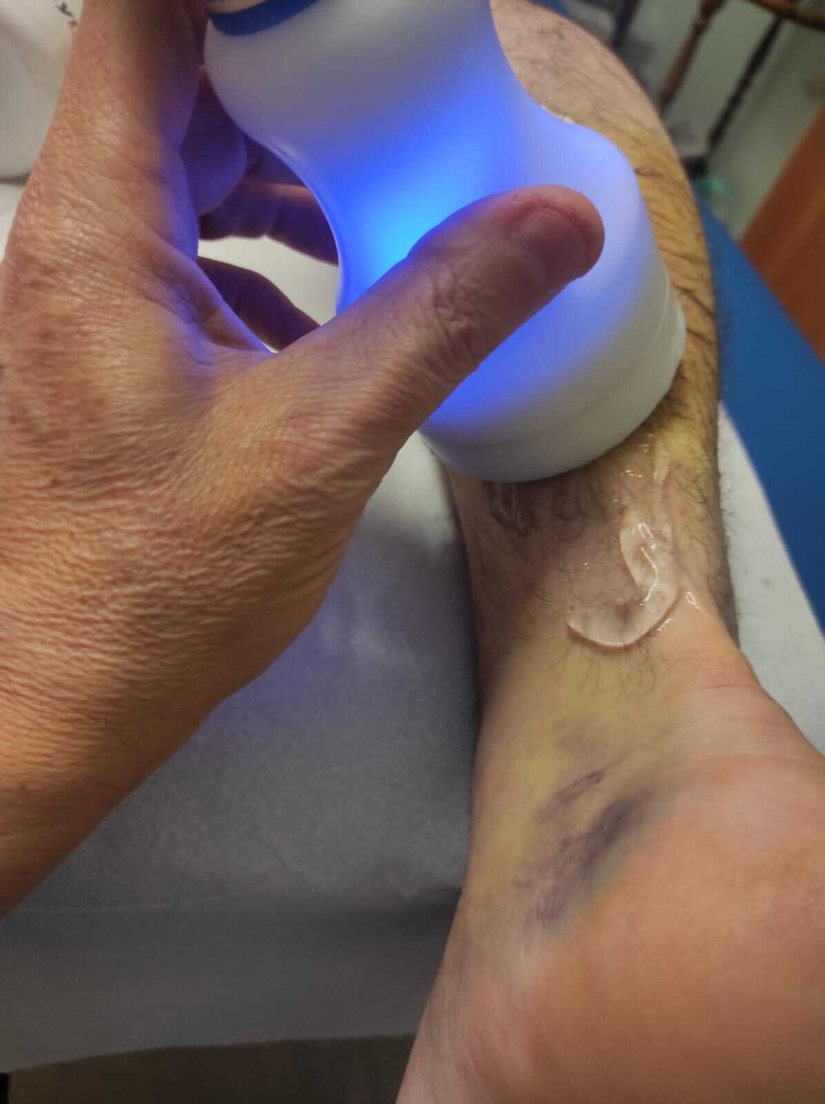 Crioterapia sull'arto inferiore