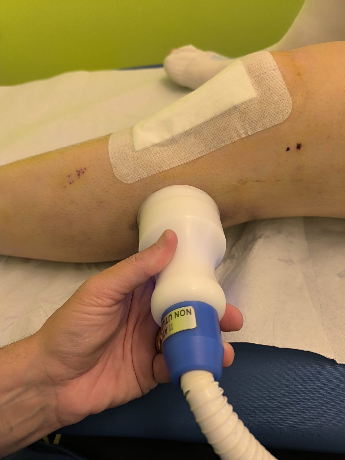 Crioterapia al ginocchio